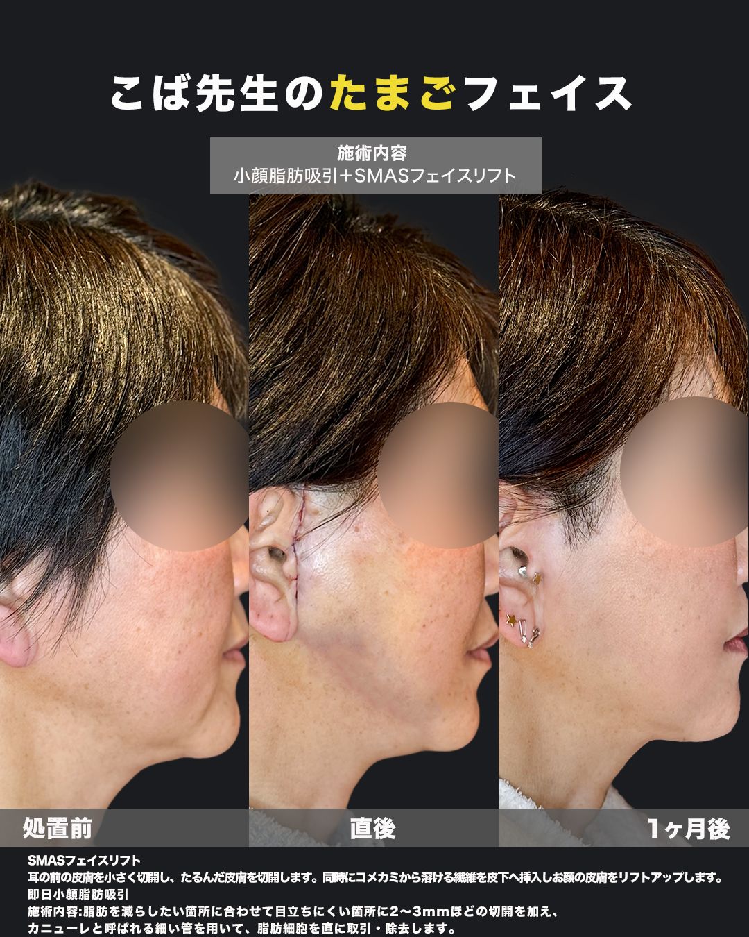 小顔脂肪吸引とSMASフェイスリフトの処置前・直後・1ヶ月後の横顔比較症例