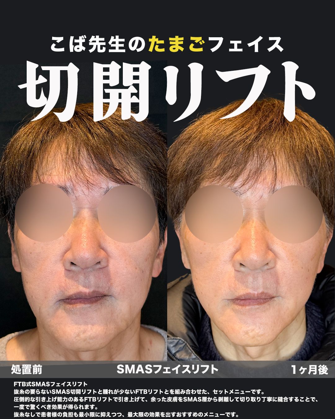 60代男性の切開リフト（FTB式SMASフェイスリフト）症例写真｜正面・処置前と1ヶ月後の比較