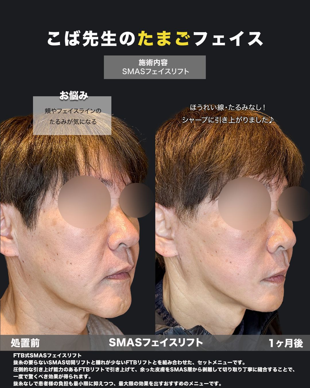 60代男性の切開リフト（FTB式SMASフェイスリフト）症例写真｜斜め・頬とフェイスラインのたるみに対する処置前と1ヶ月後の比較
