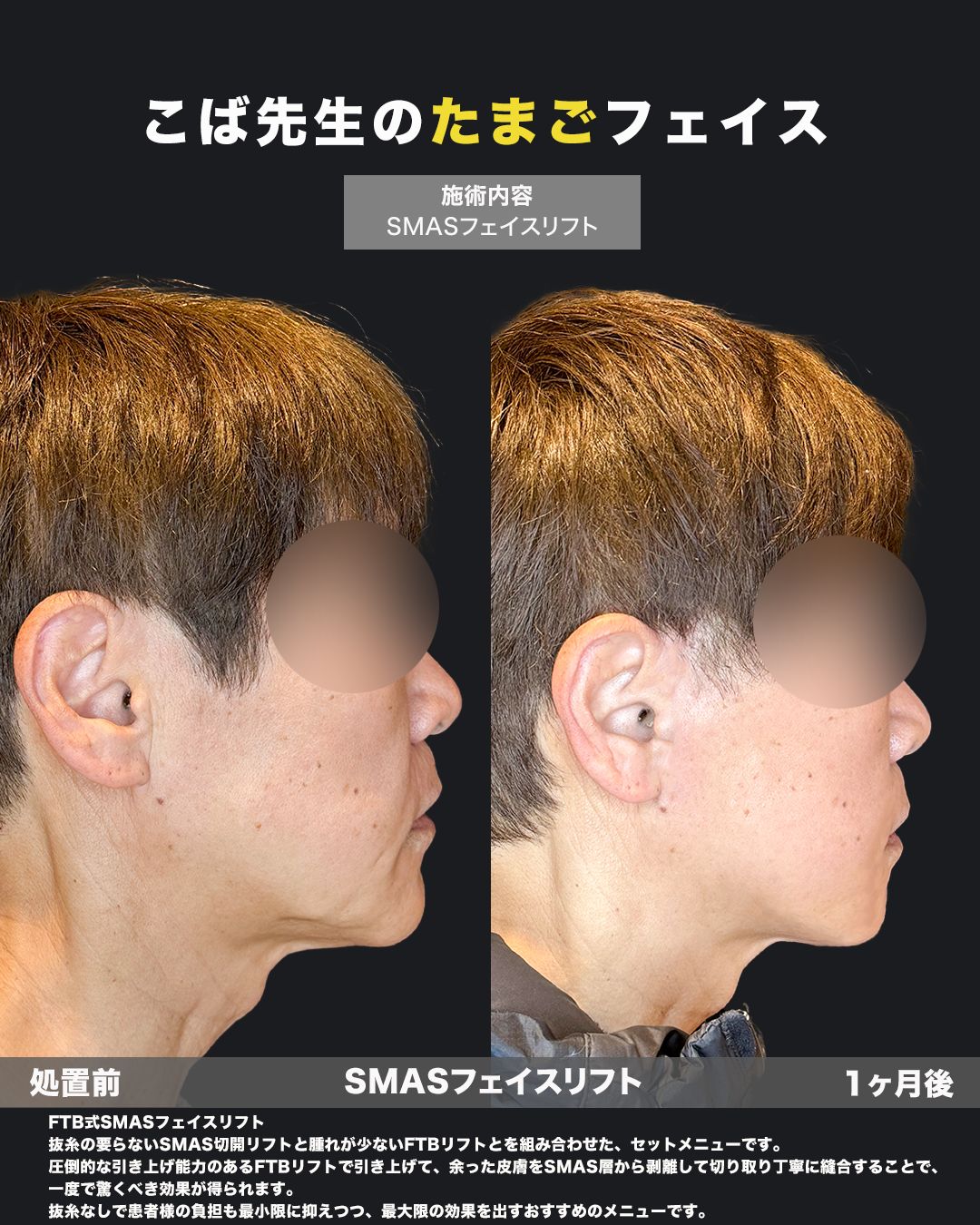60代男性の切開リフト（FTB式SMASフェイスリフト）症例写真｜側面・処置前と1ヶ月後の比較