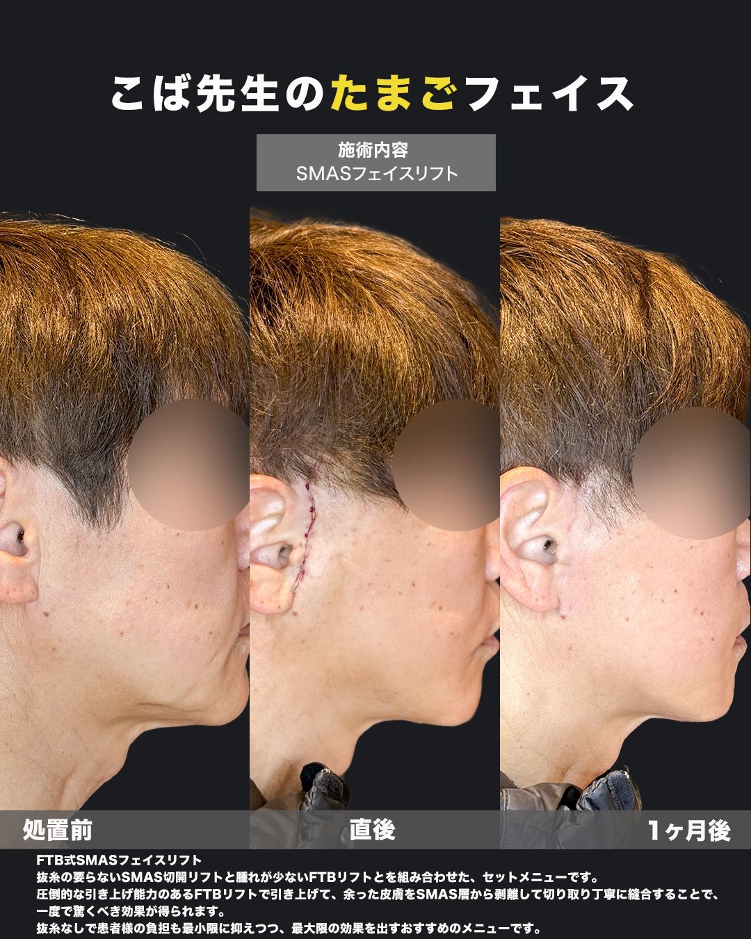 60代男性の切開リフト（FTB式SMASフェイスリフト）症例写真｜側面・処置前／直後（耳周りの縫合確認）／1ヶ月後の経過