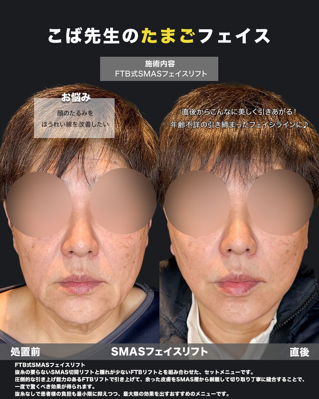 FTB式SMASフェイスリフトの症例写真（正面）。処置前は顔のたるみとほうれい線が気になる状態から、施術直後にフェイスラインが引き締まり若々しい印象へ変化