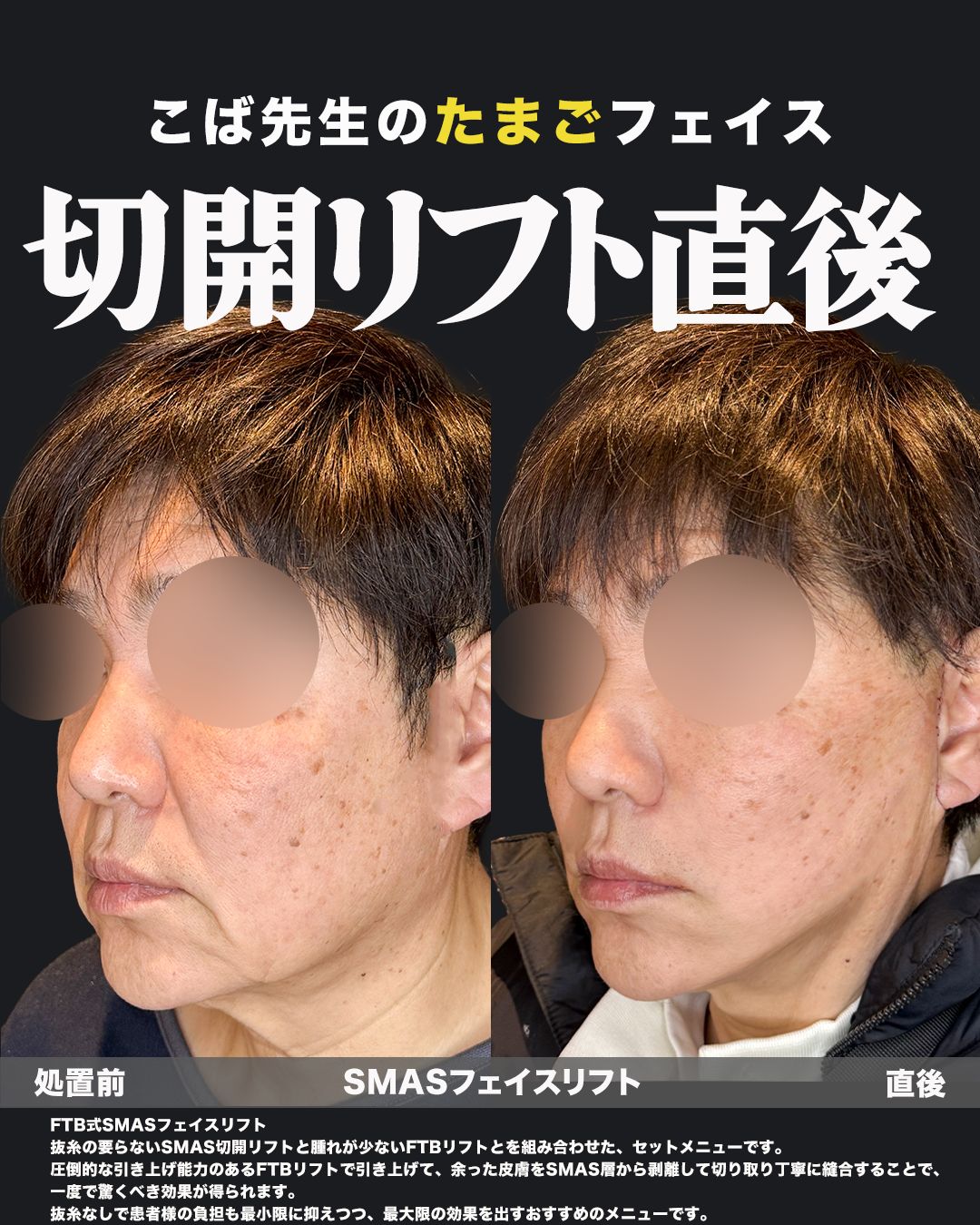 FTB式SMASフェイスリフトの症例写真（斜め45度）。切開リフト直後、フェイスラインのたるみが改善され、シャープな輪郭に