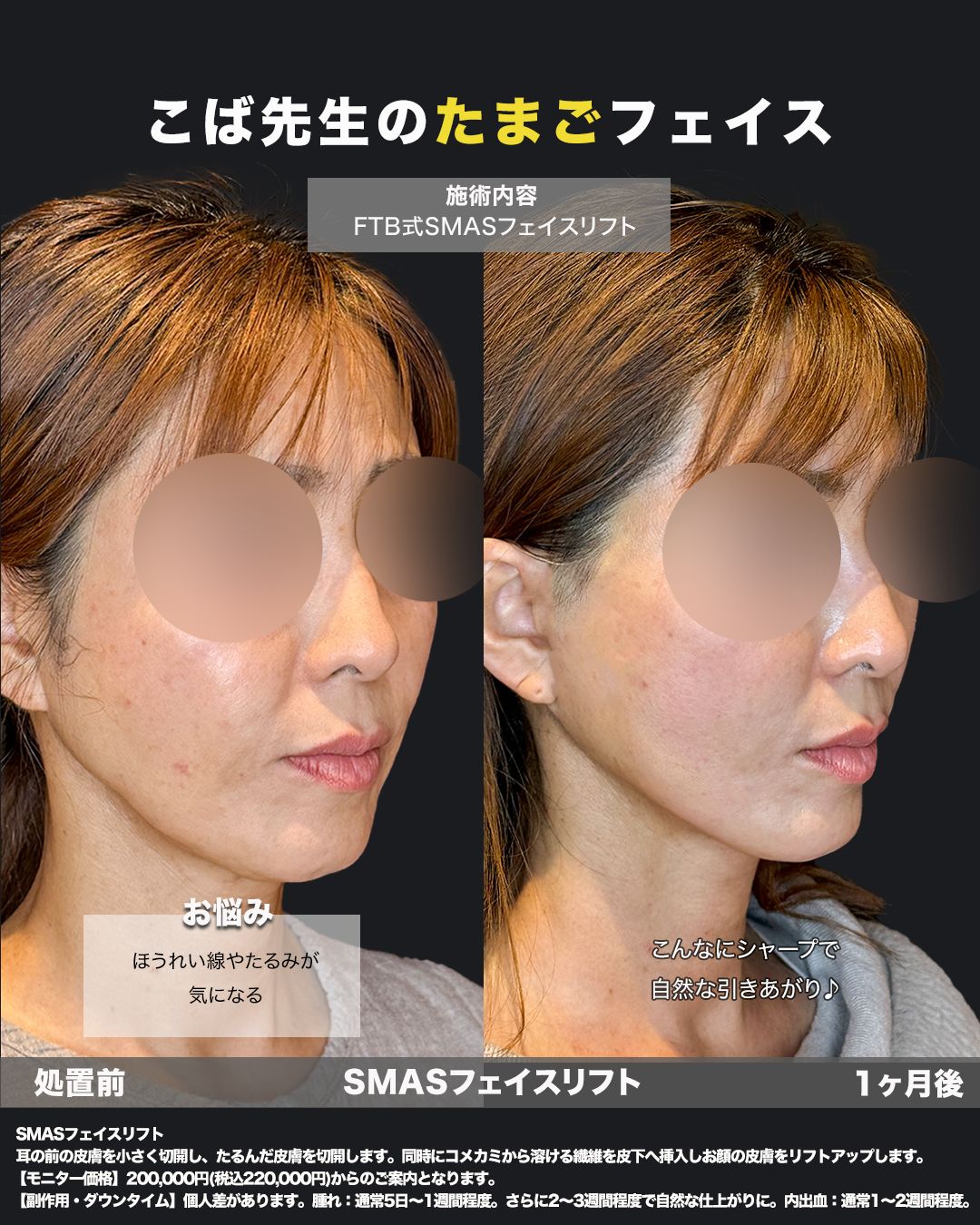 FTB式SMASフェイスリフト施術前と1ヶ月後の斜めからの比較写真（ほうれい線・たるみ改善）