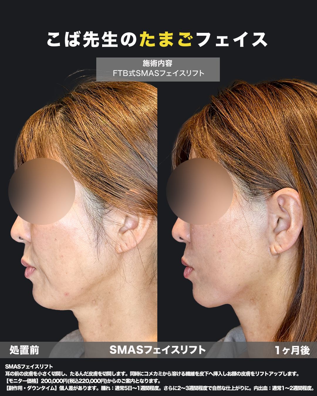 FTB式SMASフェイスリフト施術前と1ヶ月後の横顔比較写真