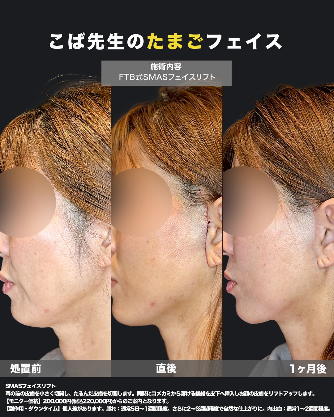 FTB式SMASフェイスリフト施術前・直後・1ヶ月後の横顔経過比較写真