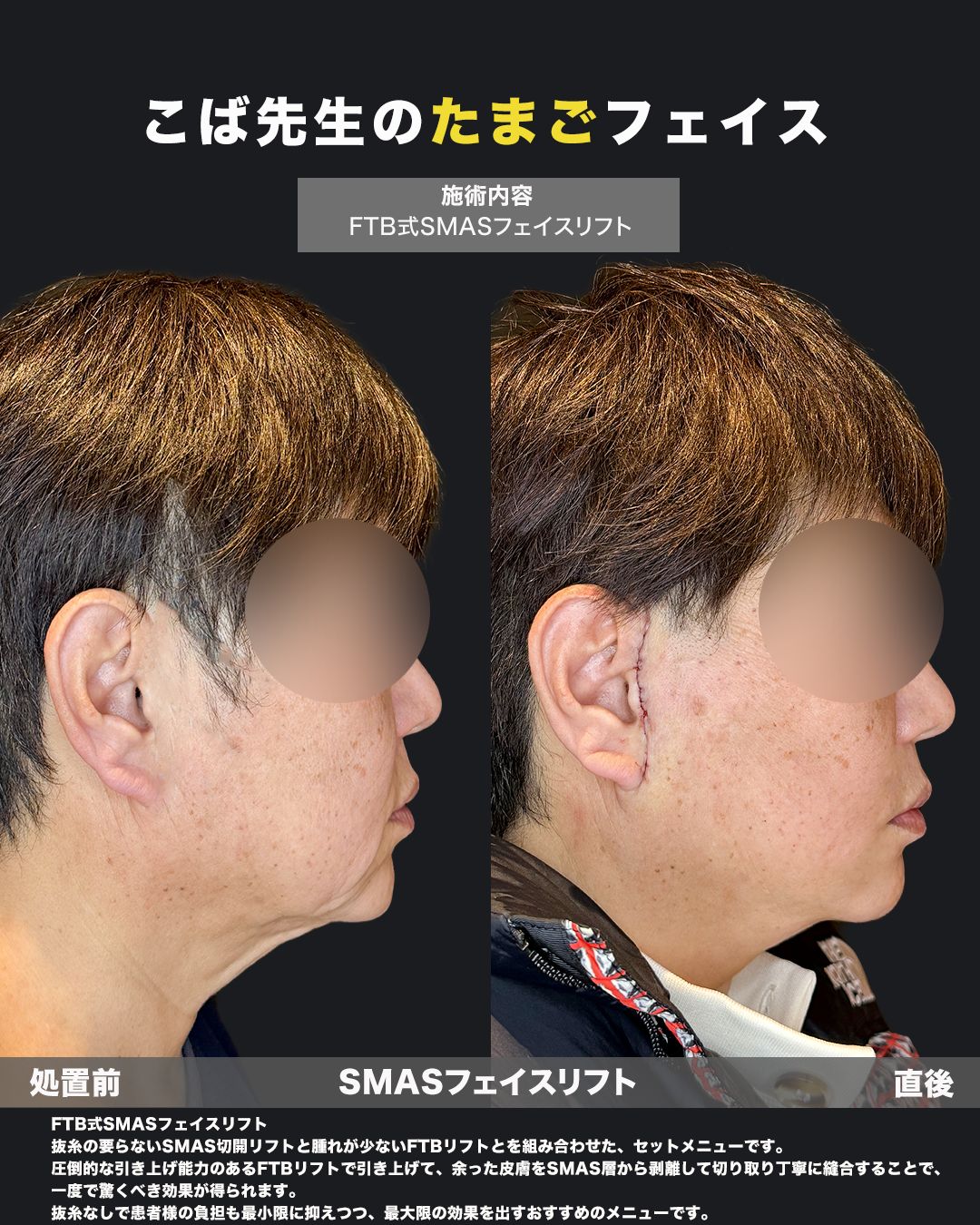 FTB式SMASフェイスリフトの症例写真（横顔）。耳周りの切開縫合ラインと、首元からフェイスラインにかけてのたるみ改善効果を確認できる