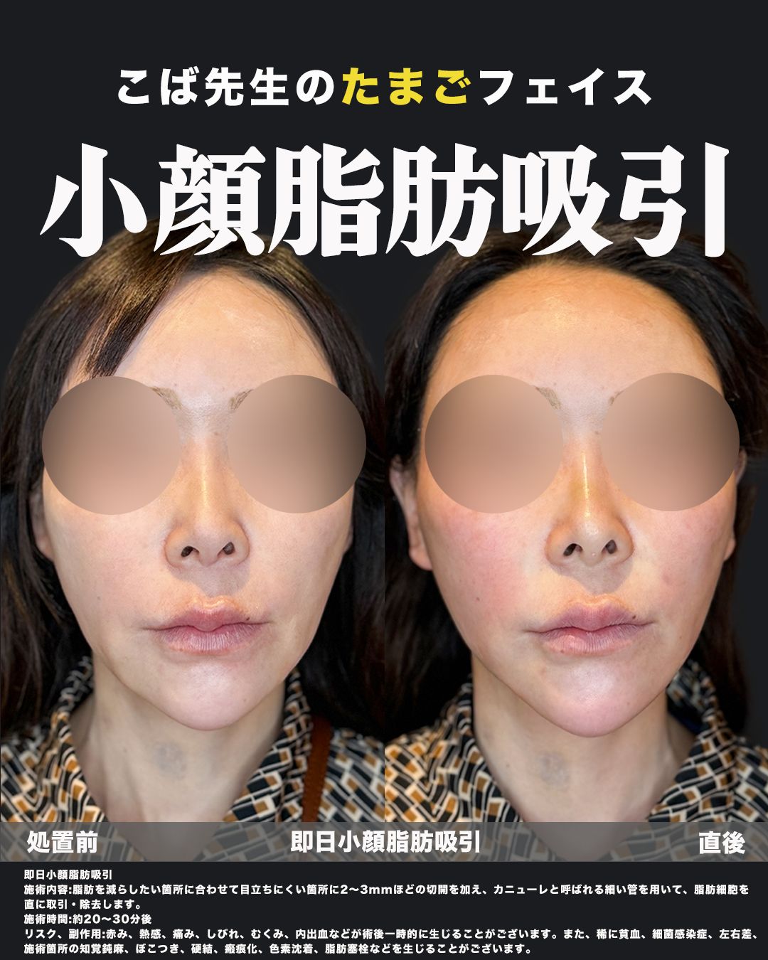 こば先生のたまごフェイス｜即日小顔脂肪吸引の正面ビフォーアフター（処置前・直後比較）