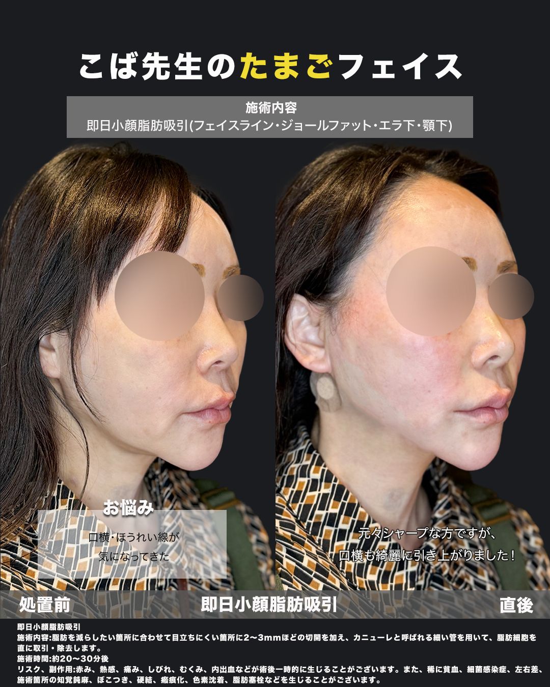 こば先生のたまごフェイス｜即日小顔脂肪吸引（フェイスライン・ジョールファット・エラ下・顎下）斜め45度のビフォーアフター、口横・ほうれい線改善症例