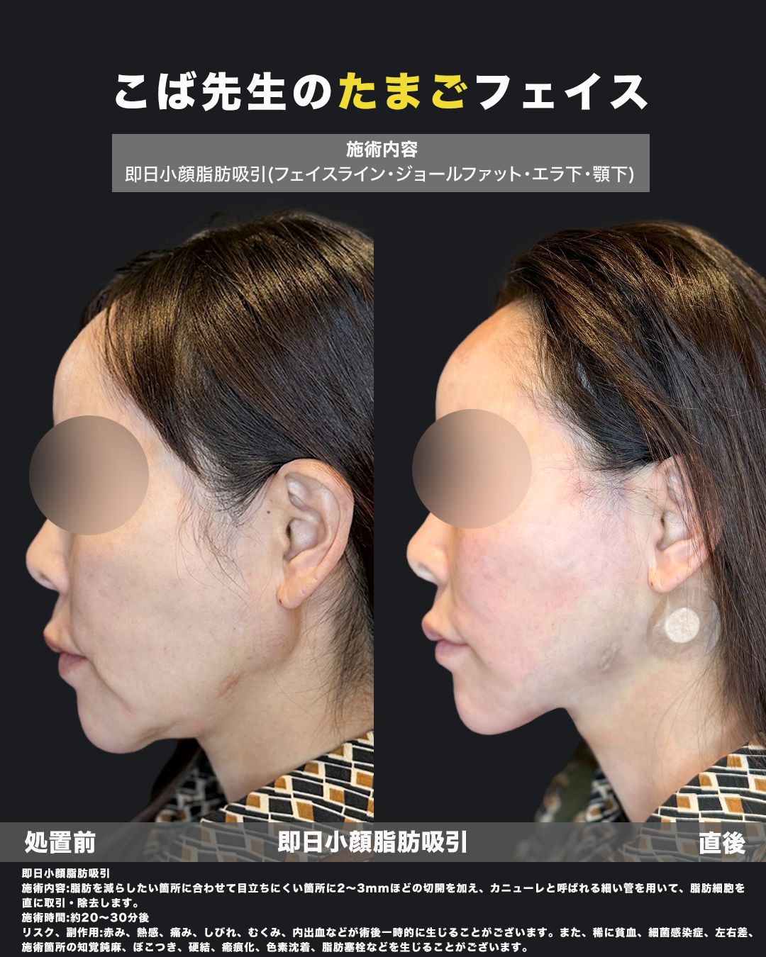 こば先生のたまごフェイス｜即日小顔脂肪吸引（フェイスライン・ジョールファット・エラ下・顎下）横顔のビフォーアフター、フェイスライン引き締め症例