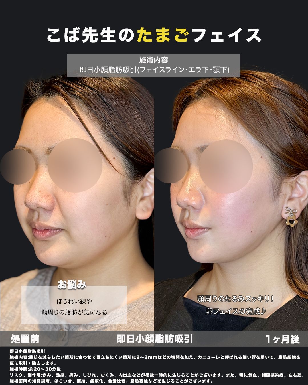 小顔脂肪吸引の処置前と1ヶ月後を斜めから比較した症例写真