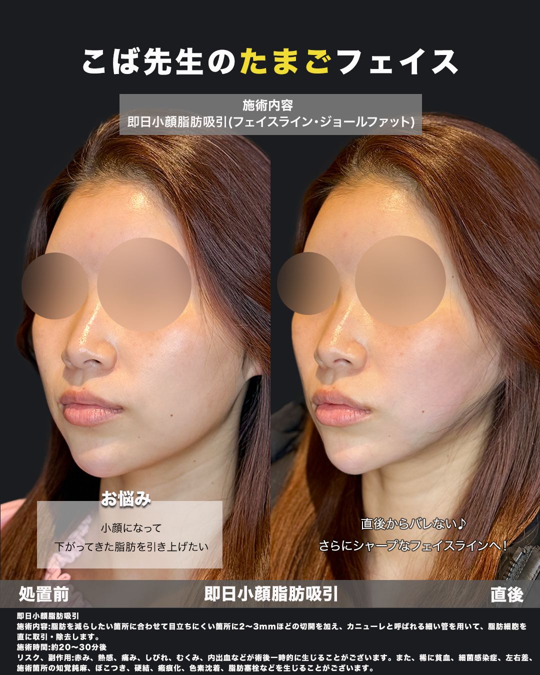 小顔脂肪吸引の斜め横顔比較画像