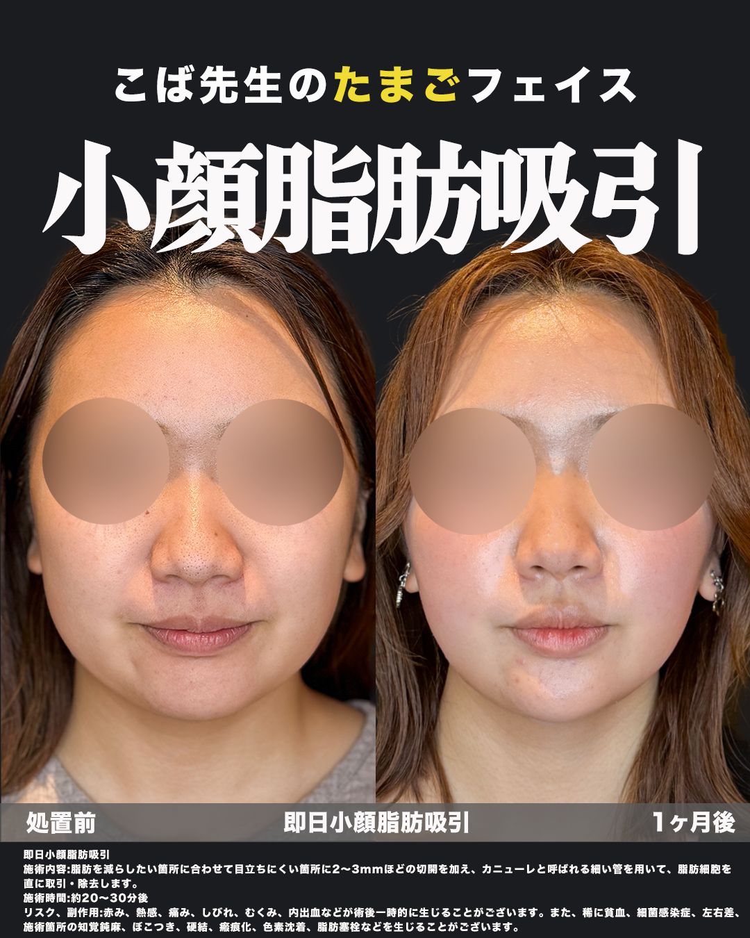 小顔脂肪吸引の処置前と1ヶ月後を正面から比較した症例写真
