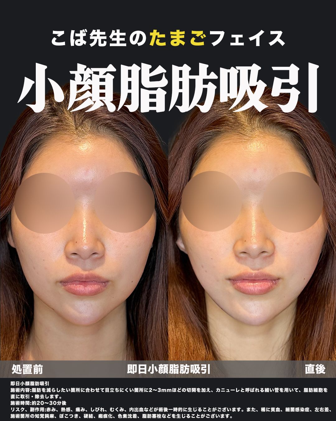 小顔脂肪吸引の正面比較画像