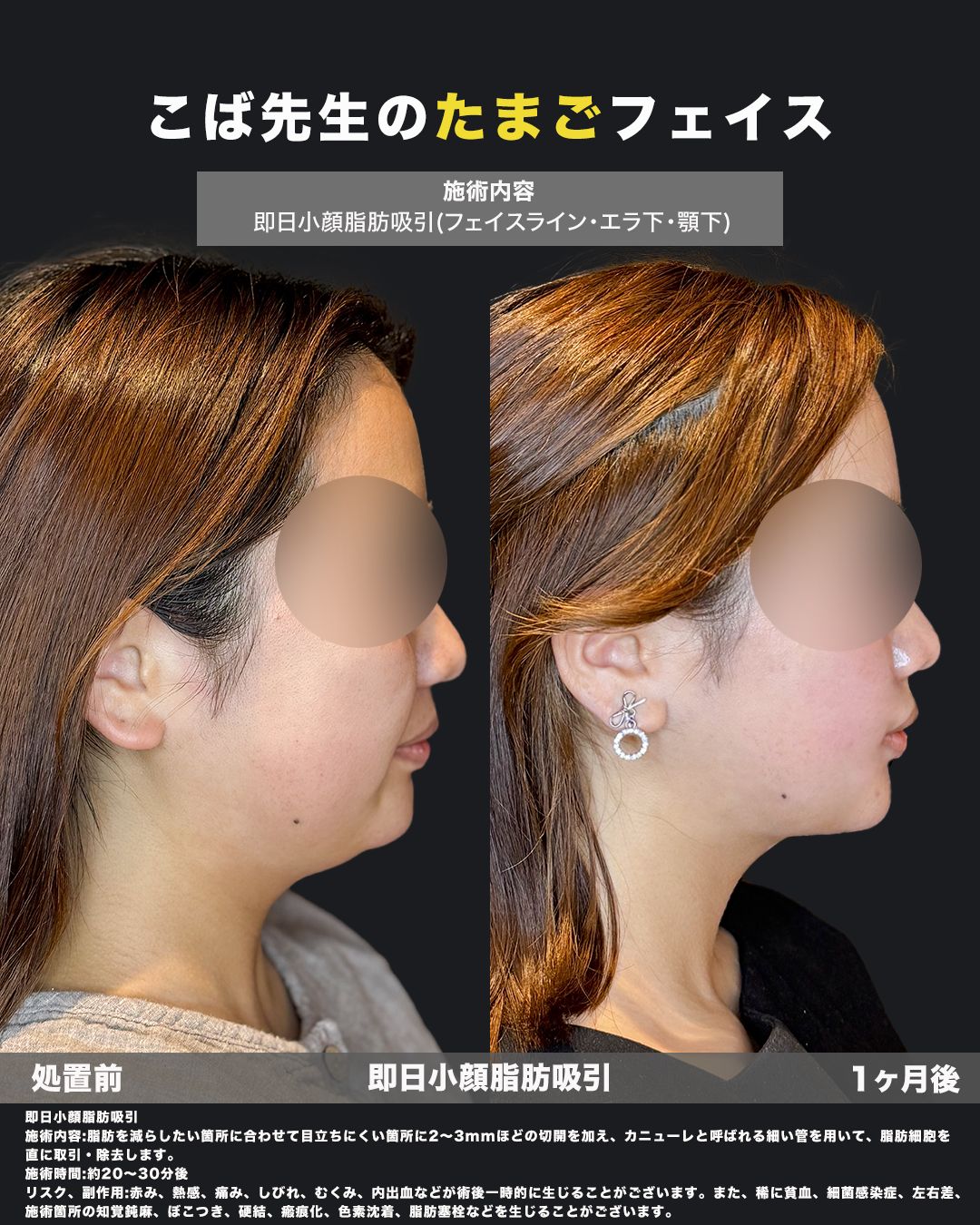 小顔脂肪吸引の処置前と1ヶ月後を横顔で比較した症例写真