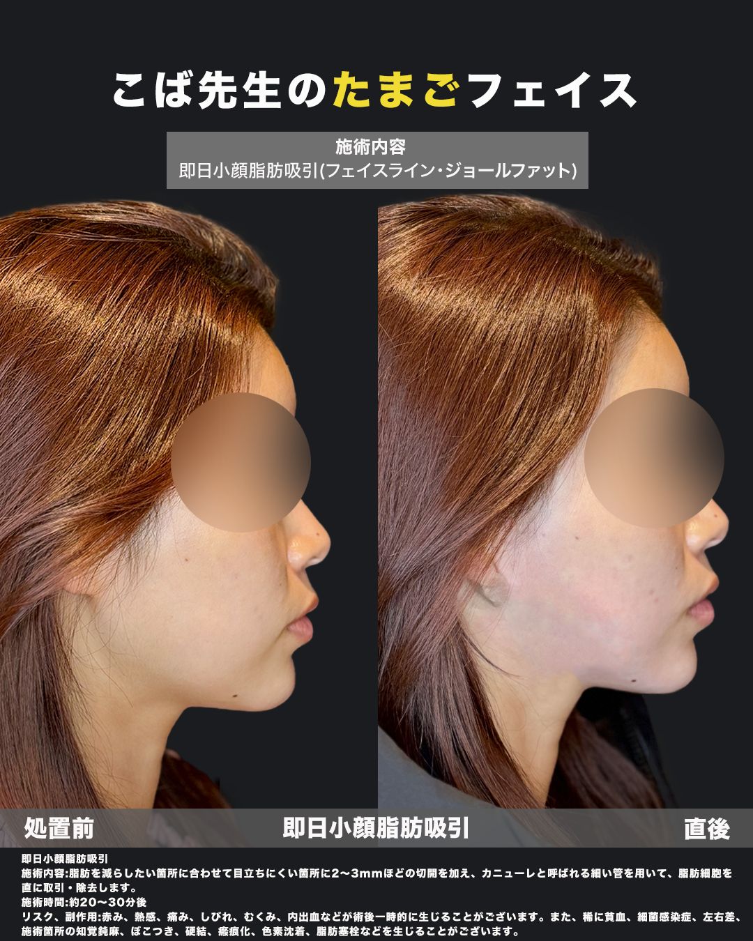 小顔脂肪吸引の横顔比較画像