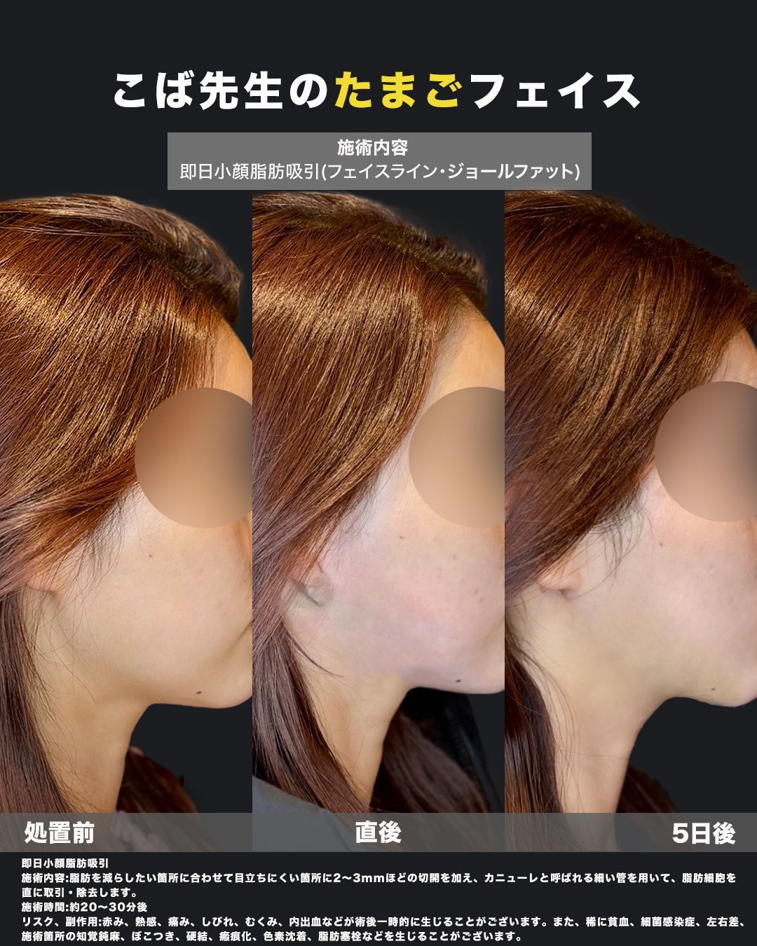 小顔脂肪吸引の処置前直後5日後の横顔比較画像