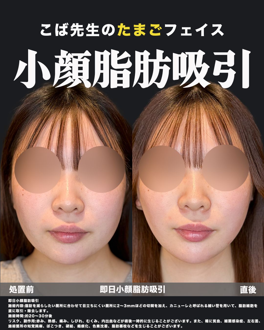 小顔脂肪吸引の処置前と直後を正面から比較した症例写真