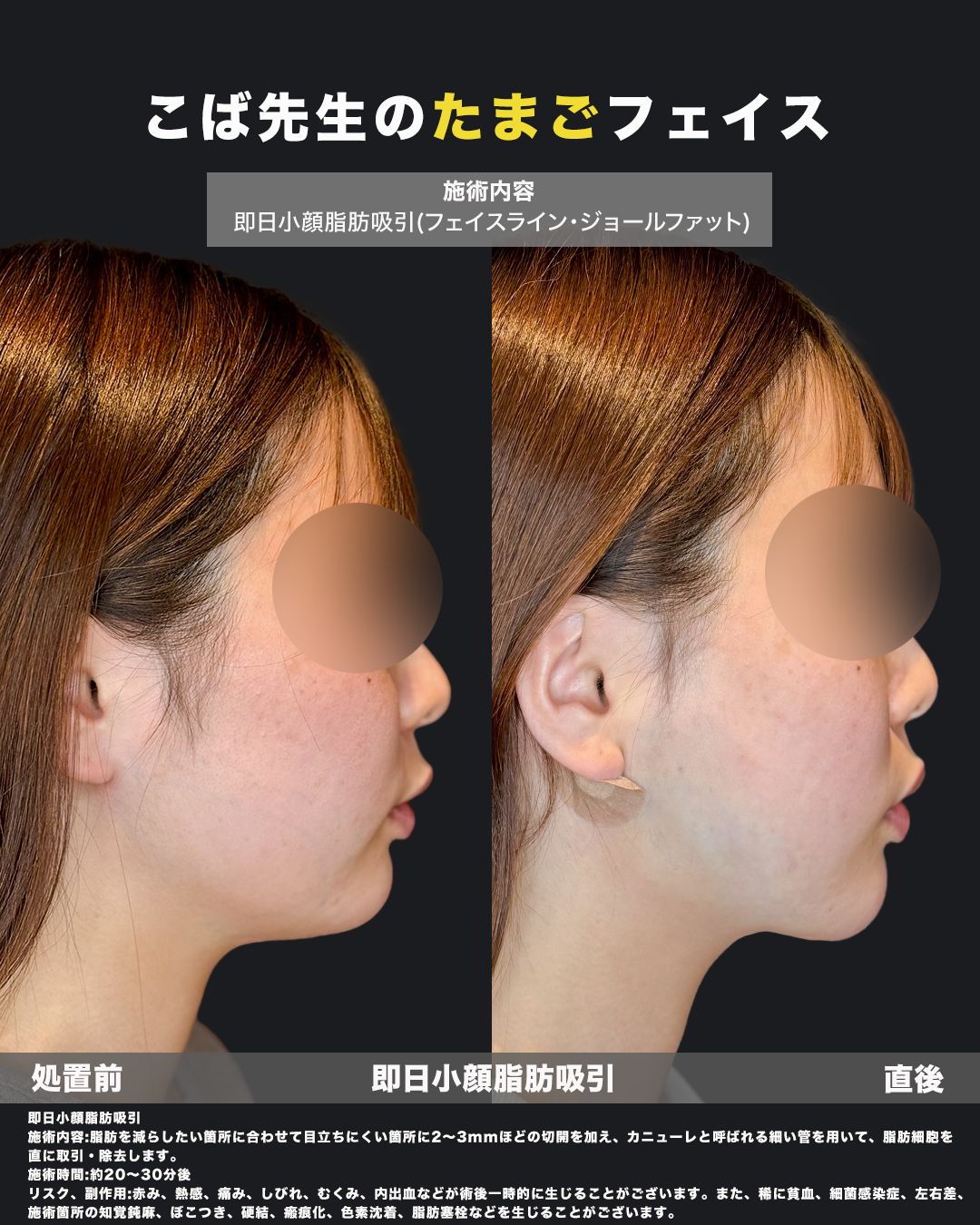 小顔脂肪吸引の処置前と直後を横顔で比較した症例写真