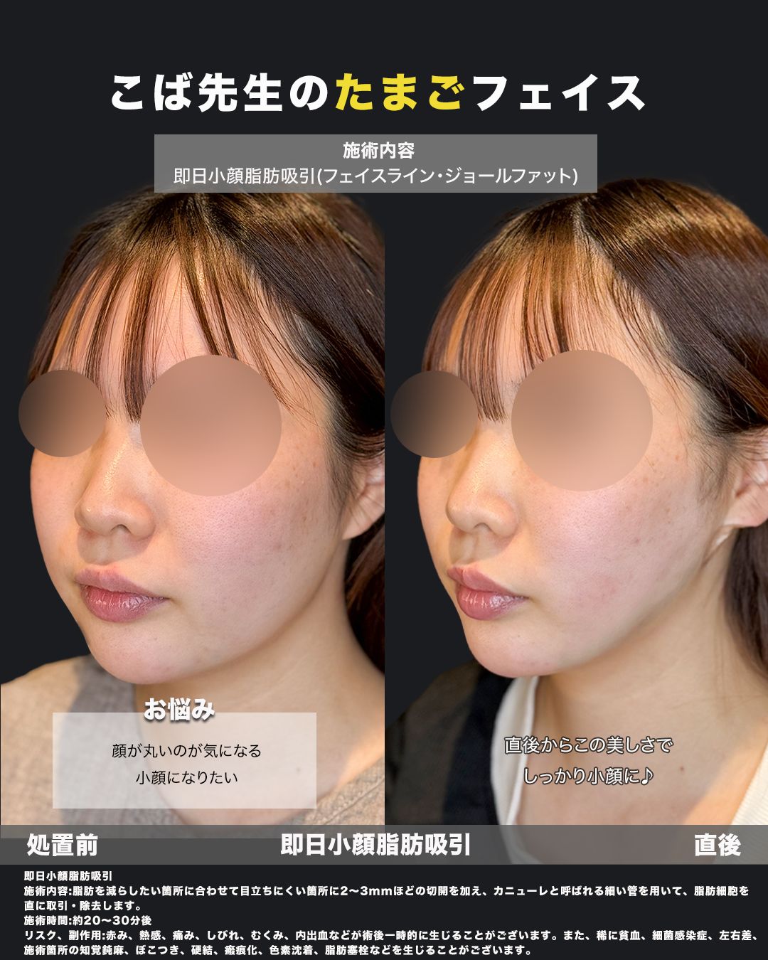 小顔脂肪吸引の処置前と直後を斜めから比較した症例写真