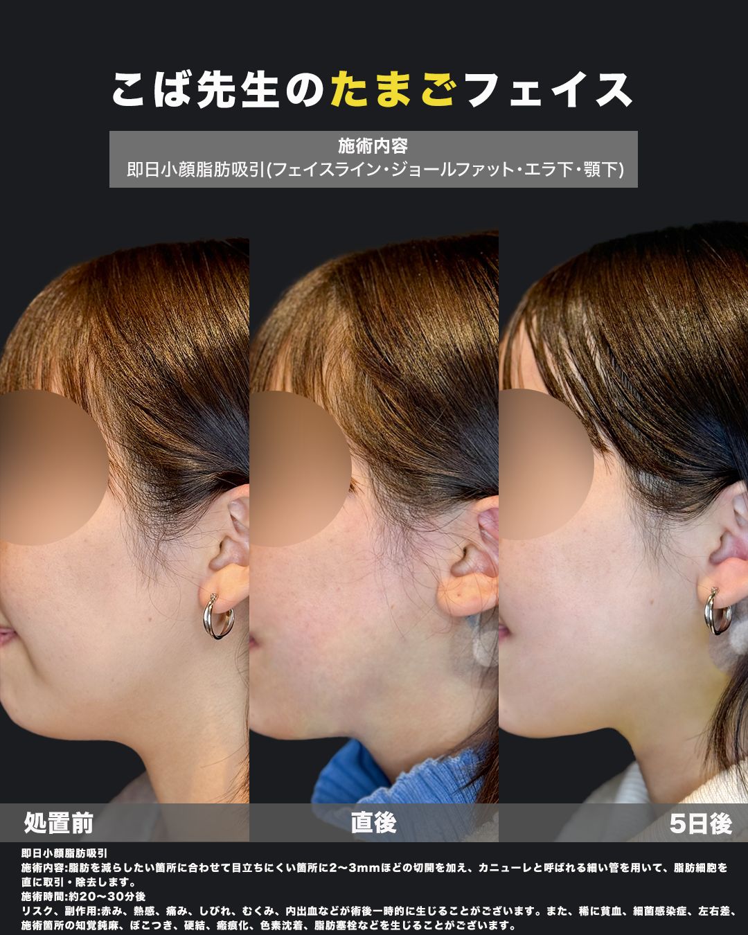 即日小顔脂肪吸引の施術前・直後・5日後を横顔で比較した女性の症例写真