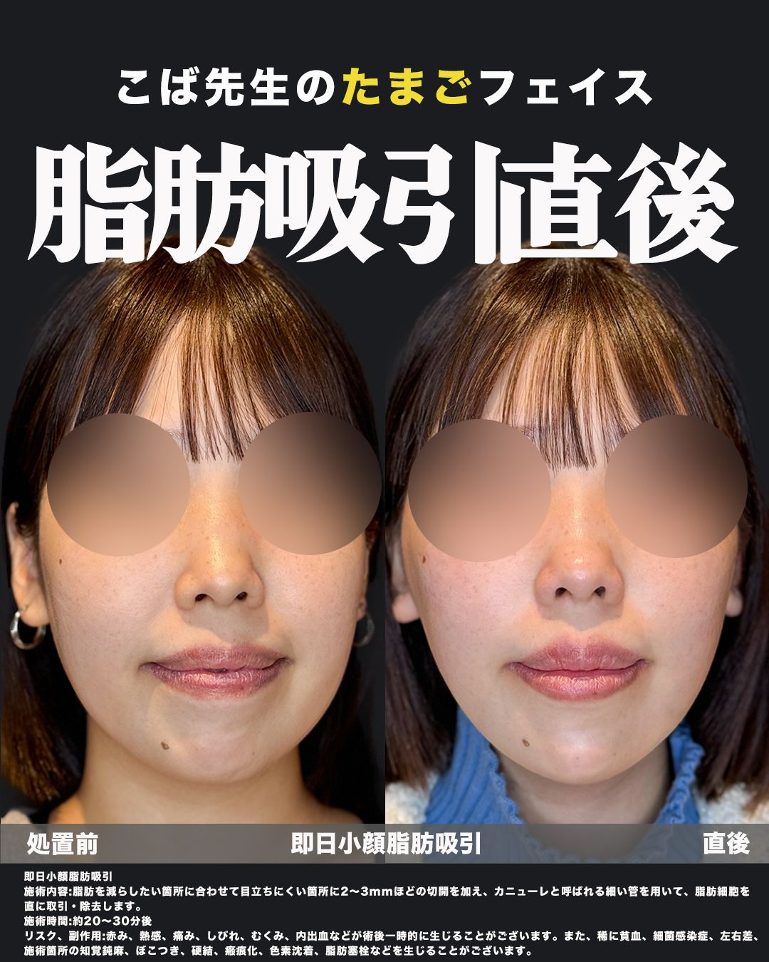 即日小顔脂肪吸引の施術前と直後を正面から比較した女性の症例写真