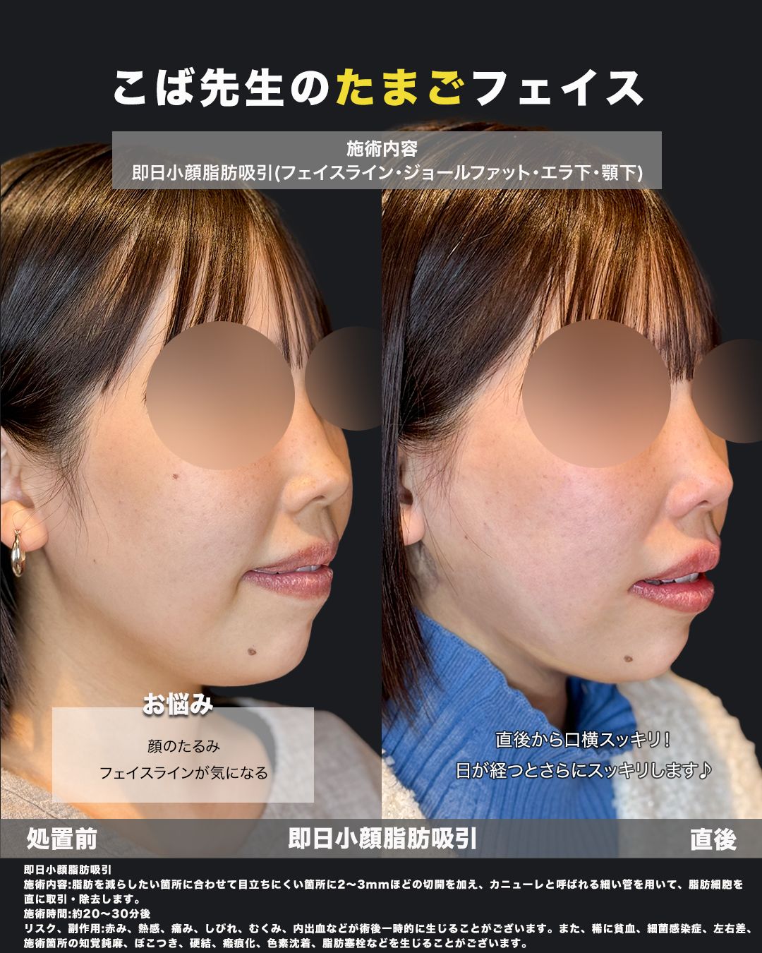 即日小顔脂肪吸引の施術前と直後を斜め横から比較した女性の症例写真