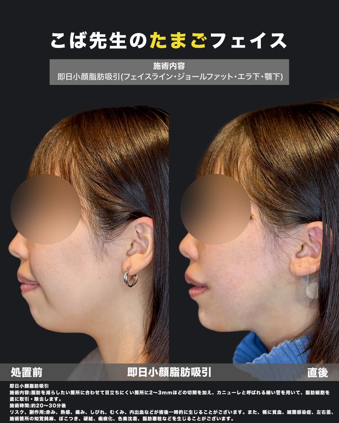即日小顔脂肪吸引の施術前と直後を横顔で比較した女性の症例写真