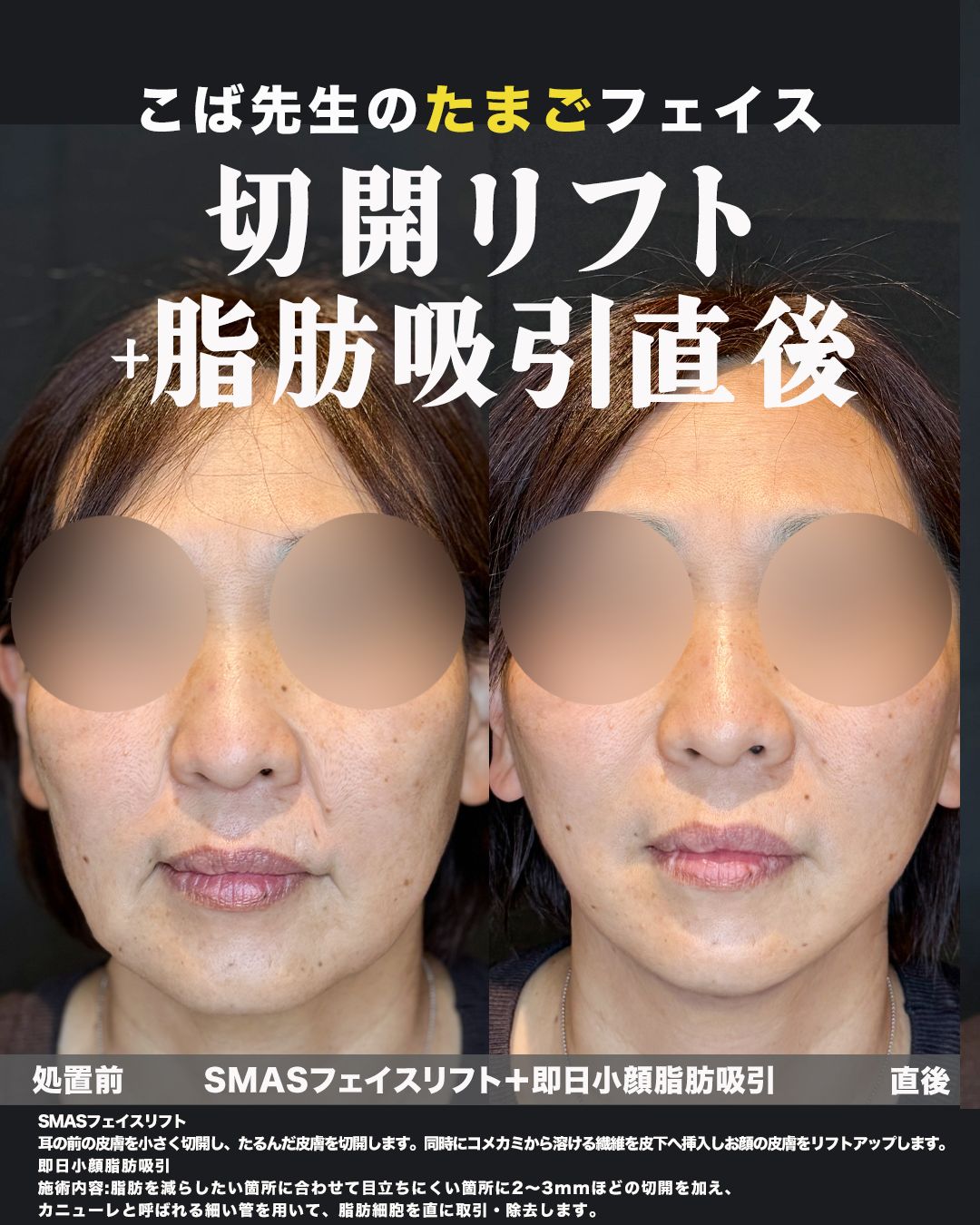 SMASフェイスリフトと小顔脂肪吸引の正面比較写真