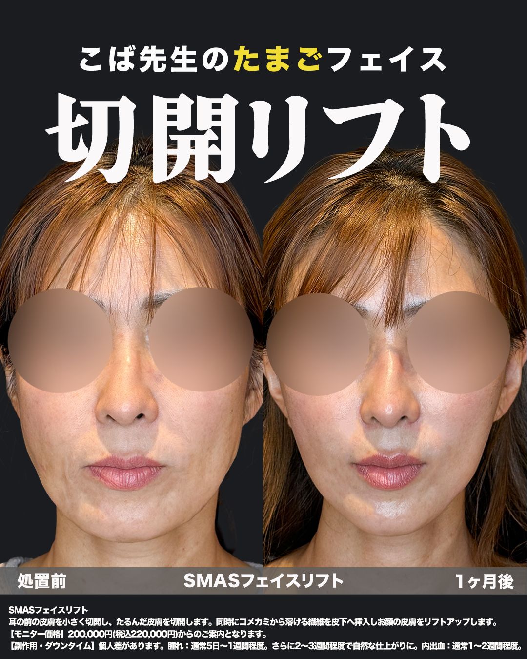 切開リフト（SMASフェイスリフト）施術前と1ヶ月後の正面比較写真
