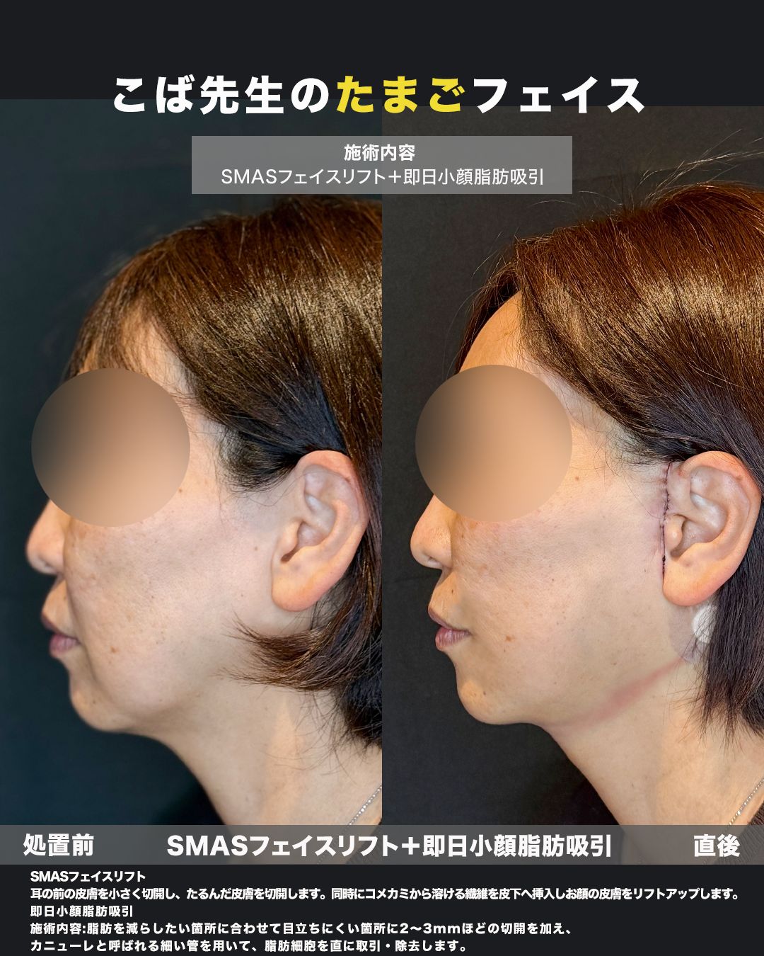SMASフェイスリフトと小顔脂肪吸引の横顔比較写真