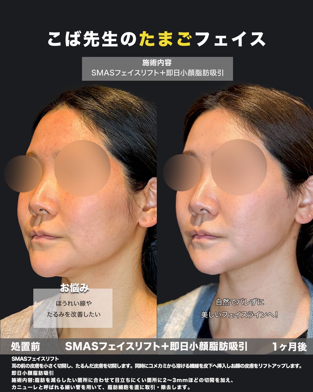 SMASフェイスリフトと小顔脂肪吸引の斜め角度の比較写真