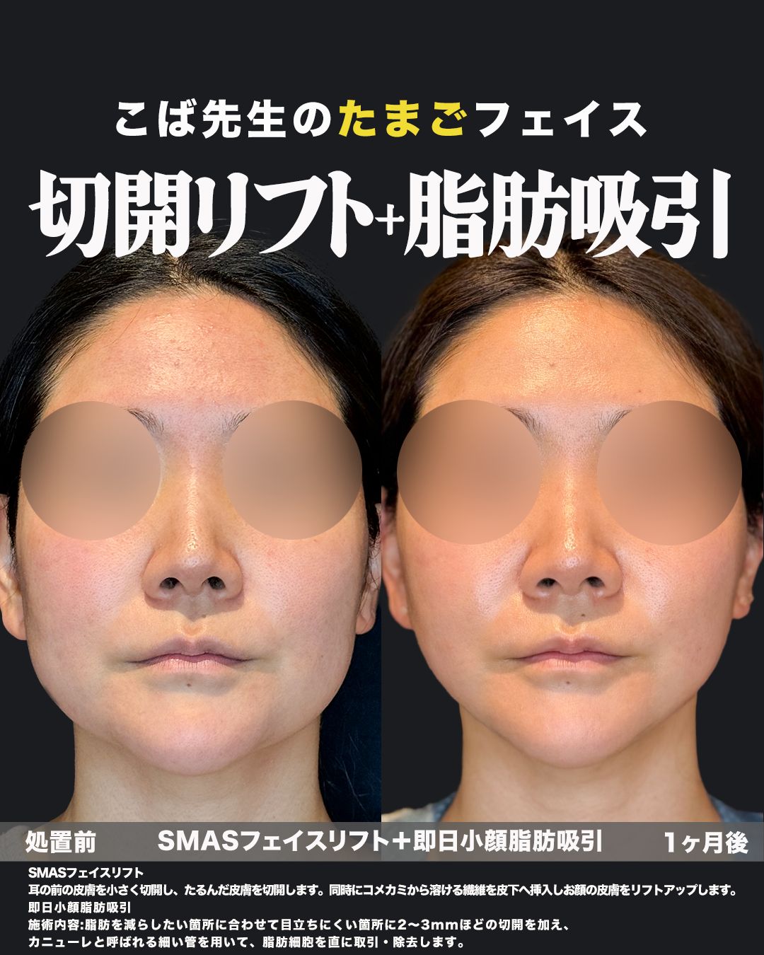 SMASフェイスリフトと小顔脂肪吸引の正面比較写真