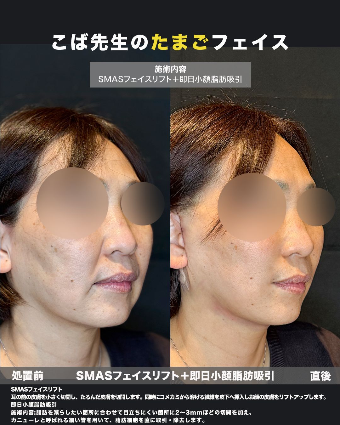 SMASフェイスリフトと小顔脂肪吸引の斜め比較写真