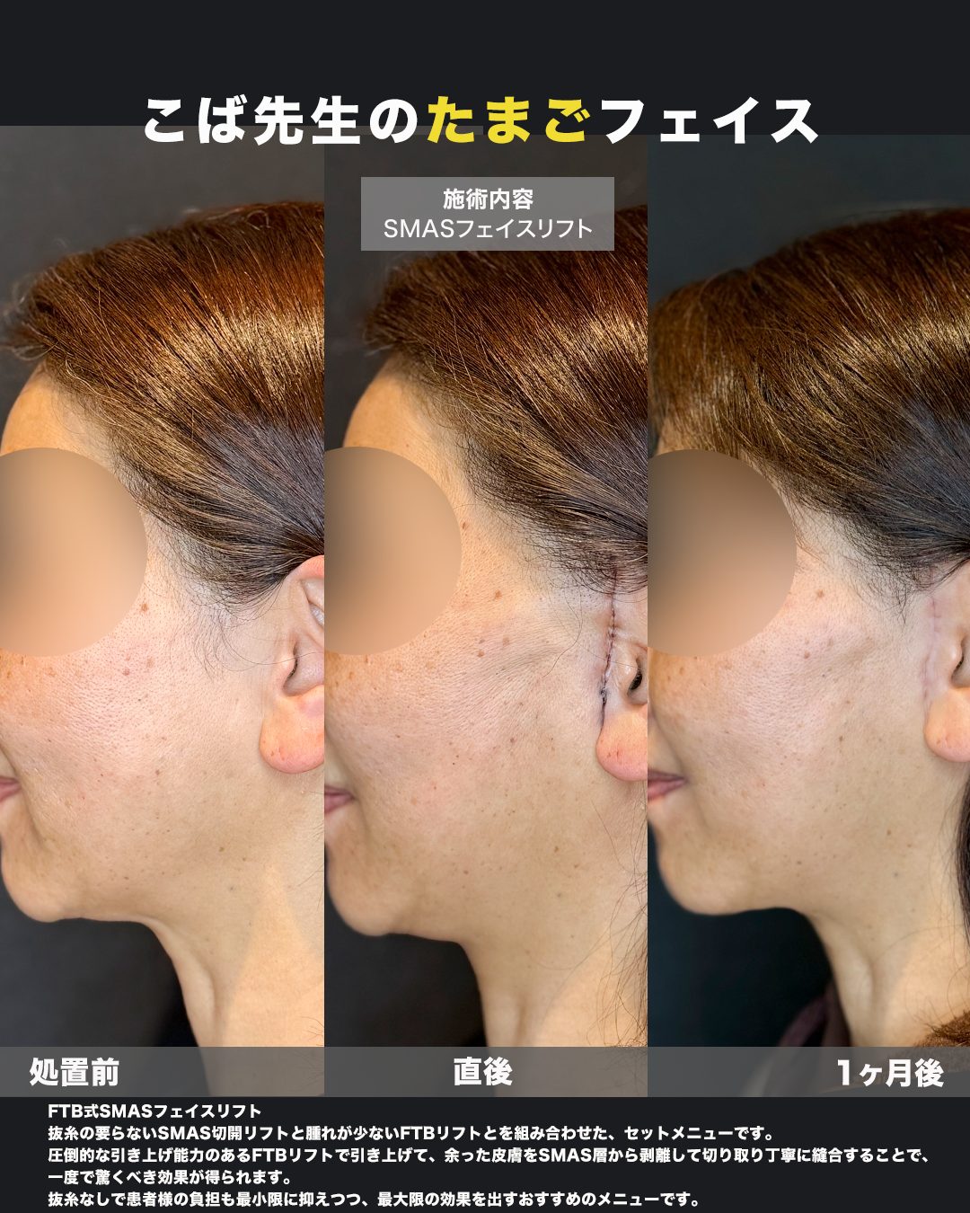 切開リフト（フェイスリフト）の症例写真（施術前後の比較）