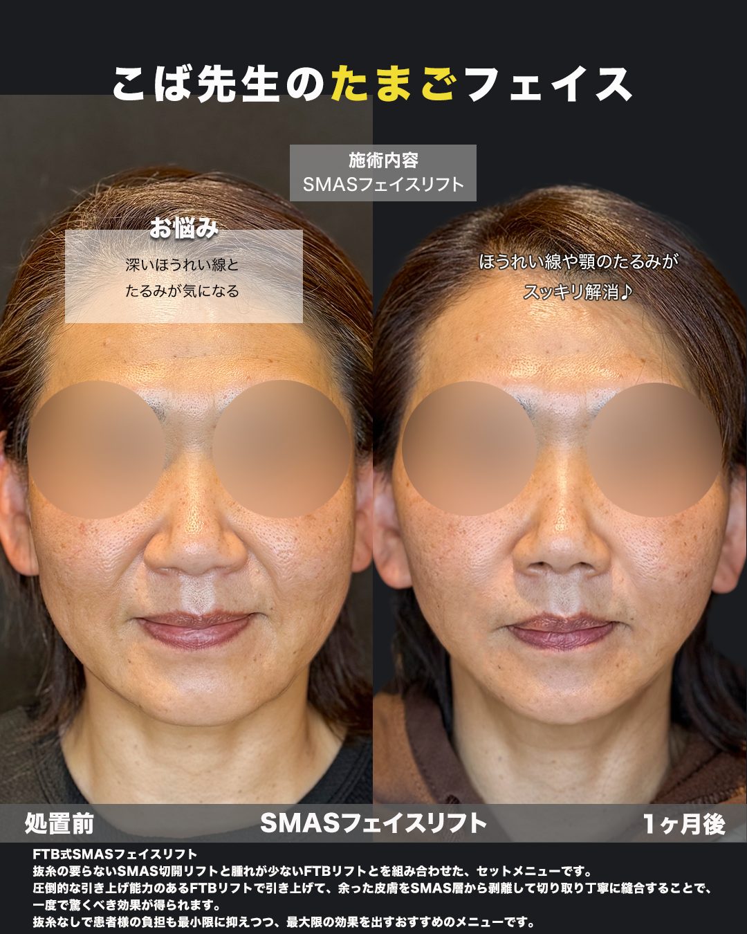 切開リフト（フェイスリフト）の症例写真（正面）