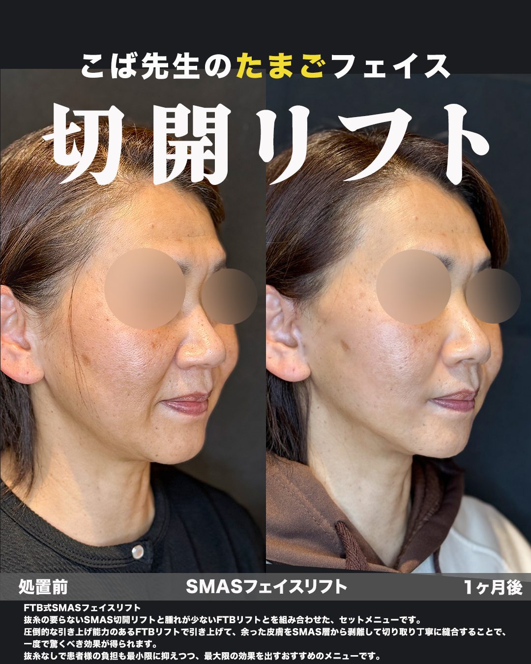切開リフト（フェイスリフト）の症例写真（斜め）