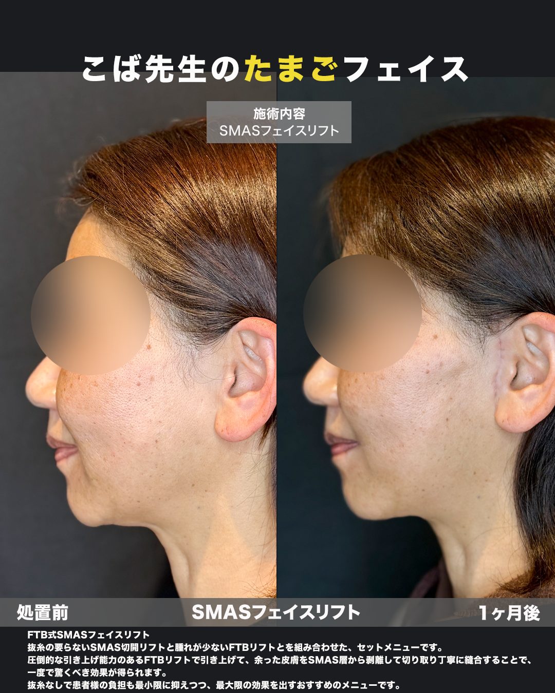 切開リフト（フェイスリフト）の症例写真（横）