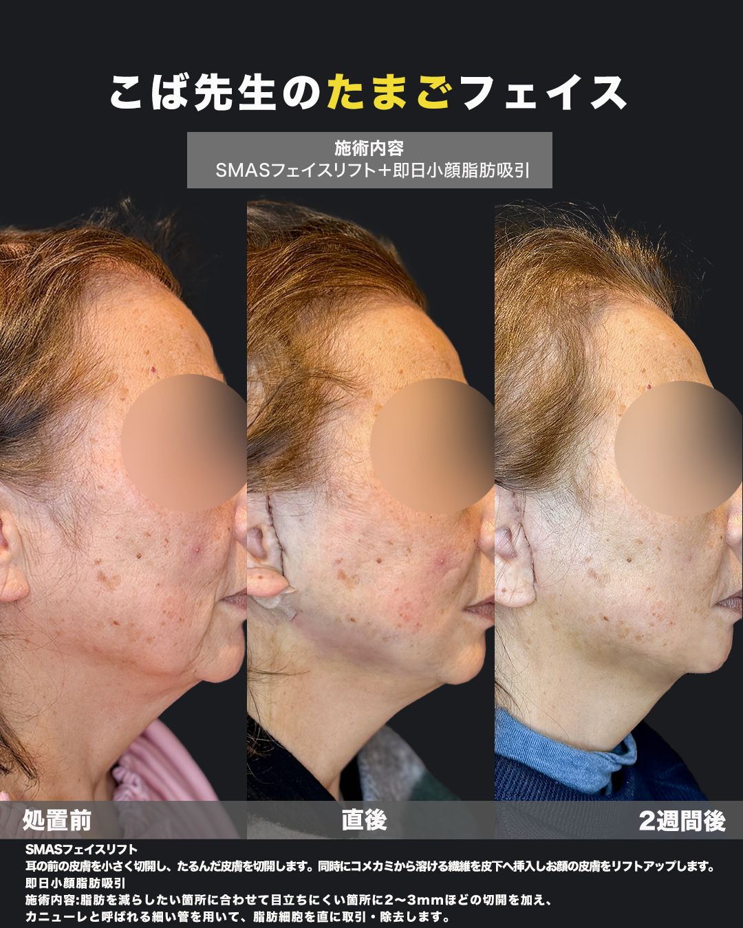 フェイスリフトと小顔脂肪吸引の処置前・直後・2週間後の横顔比較写真