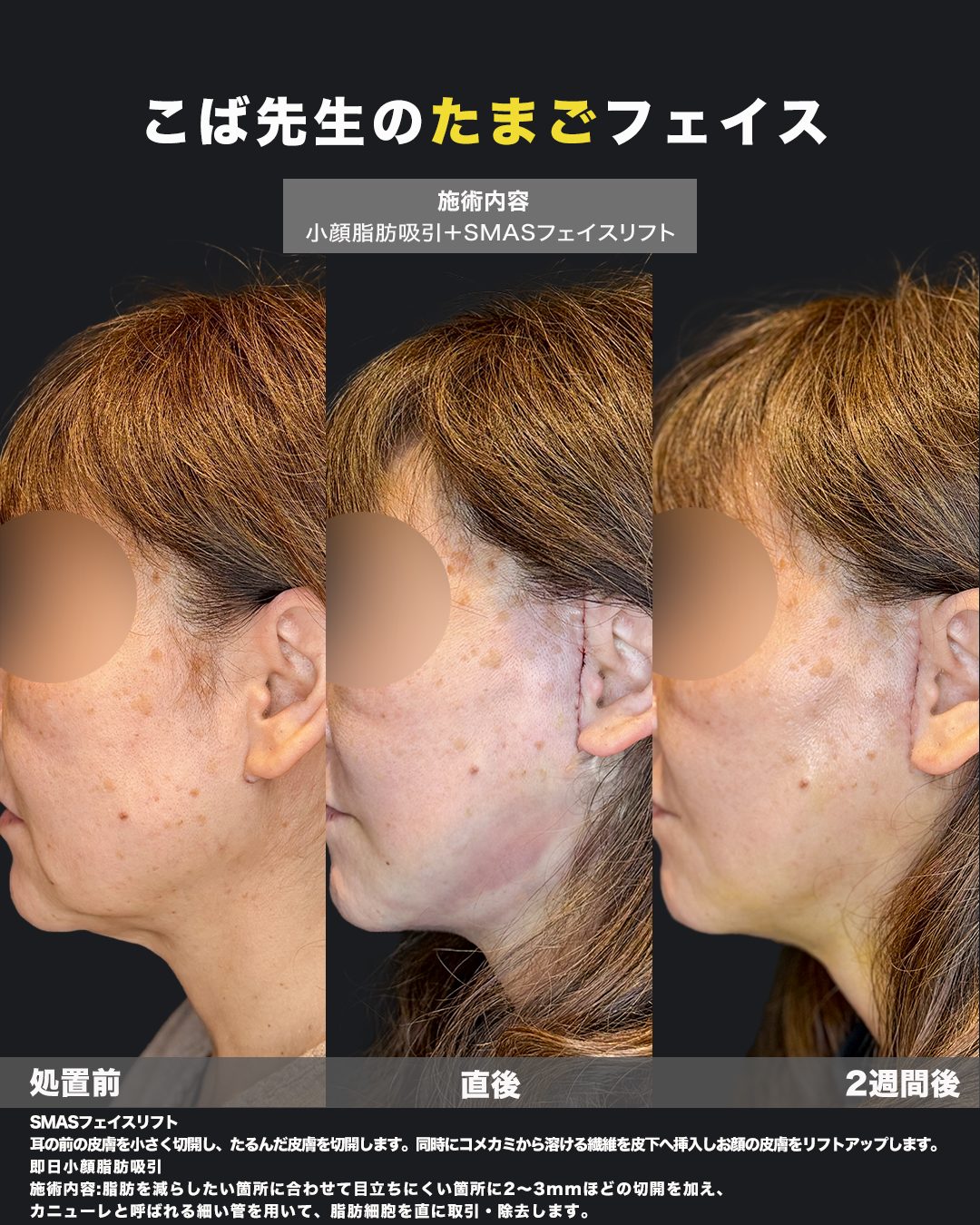 福岡天神美容クリニックの切開リフト（SMASフェイスリフト）＋小顔脂肪吸引 症例 施術前後の比較写真