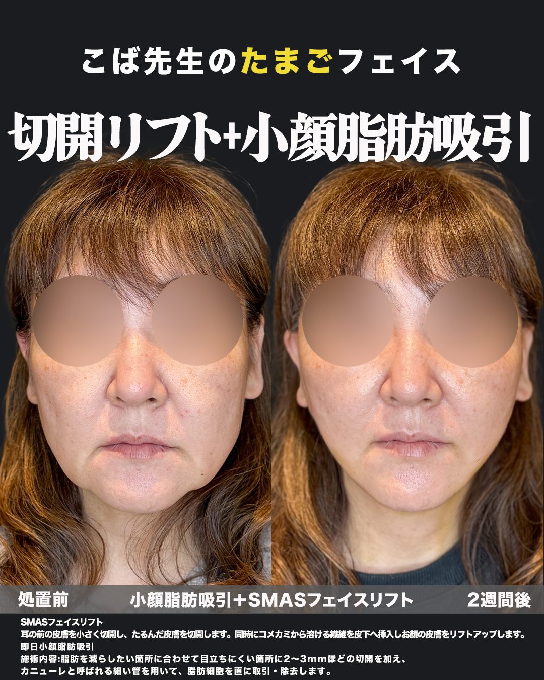 福岡天神美容クリニックの切開リフト（SMASフェイスリフト）＋小顔脂肪吸引 症例 正面 施術前と施術直後の比較