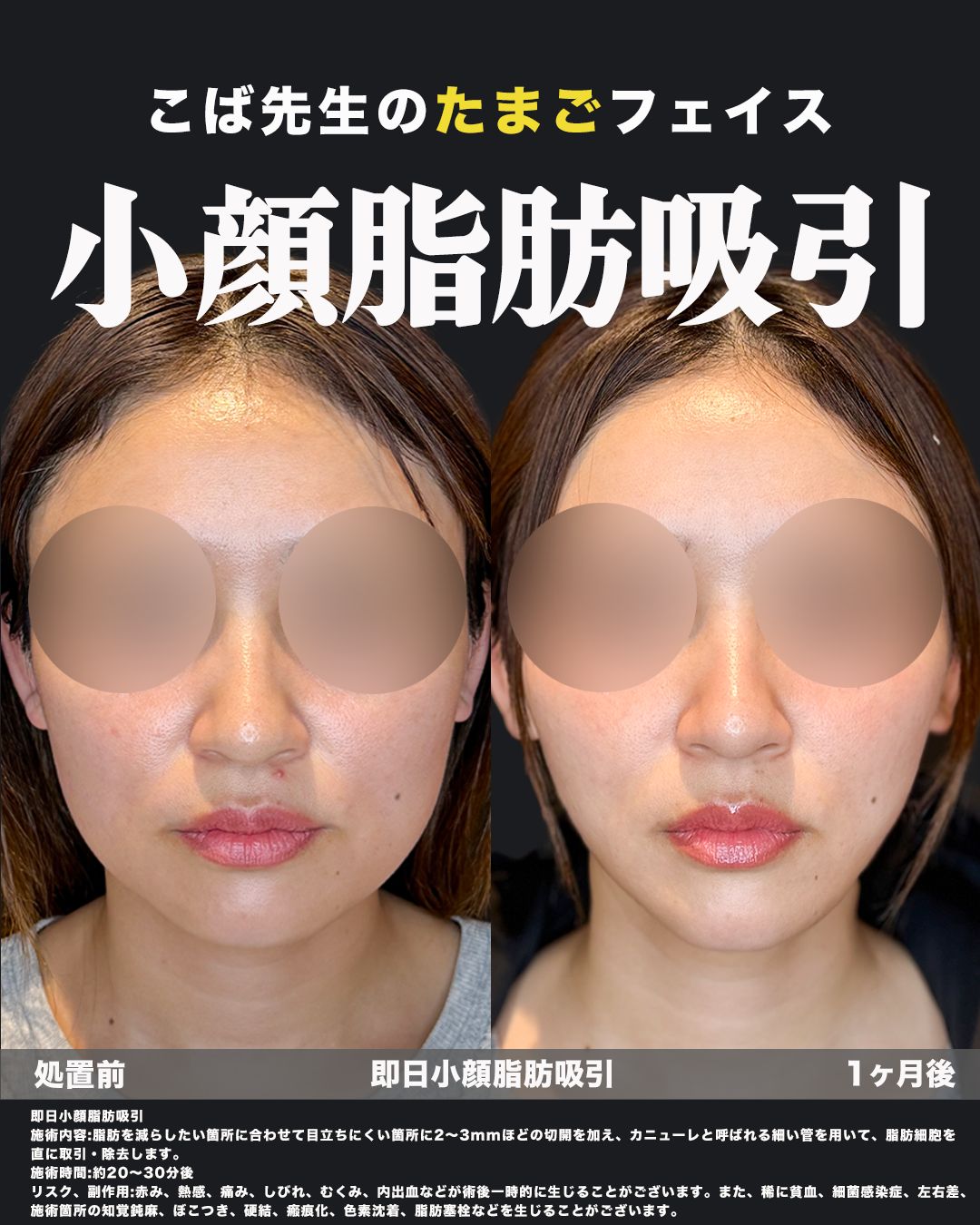 即日小顔脂肪吸引（頬・ジョール・エラ・あご下）の症例 正面