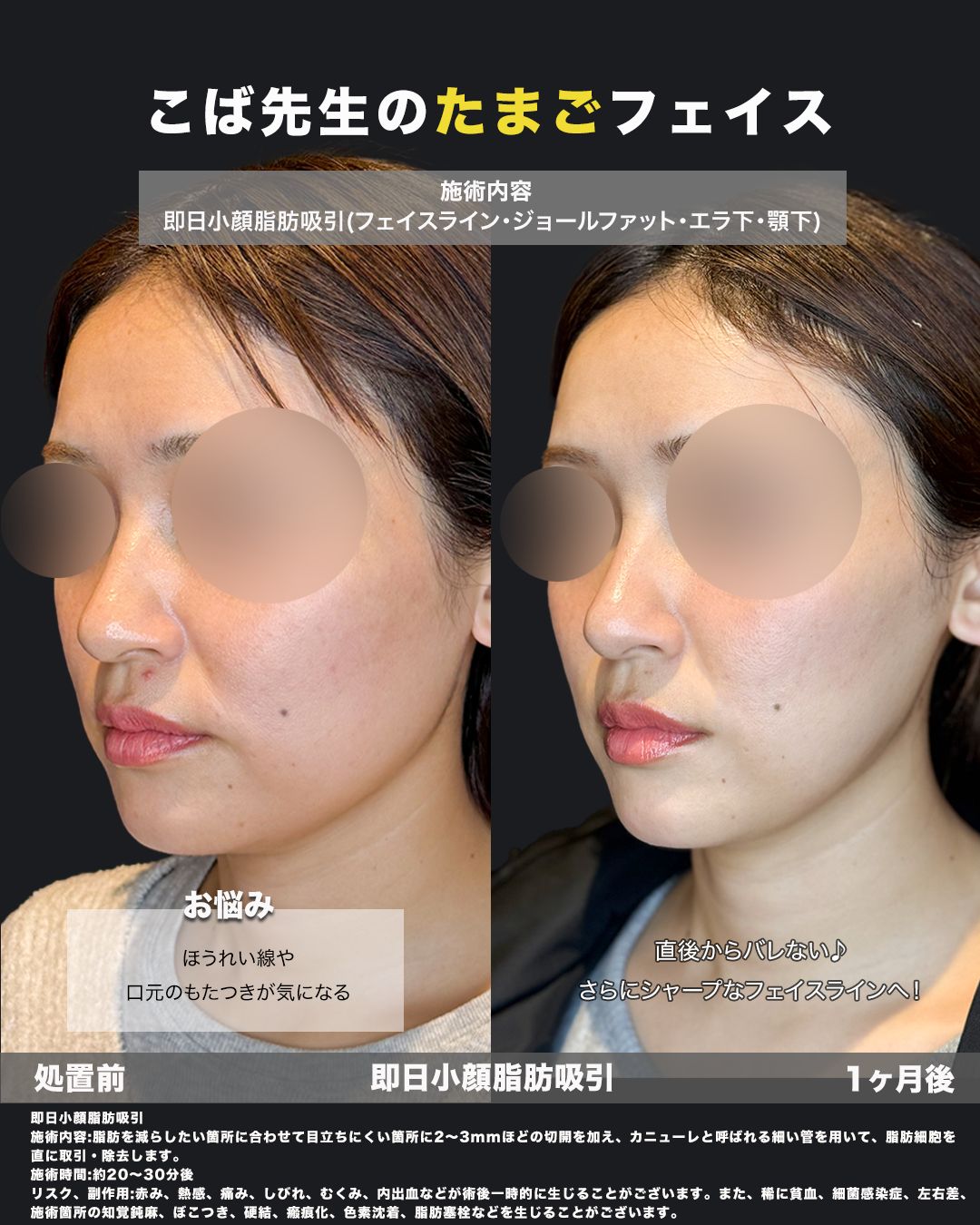 即日小顔脂肪吸引（頬・ジョール・エラ・あご下）の症例 斜め