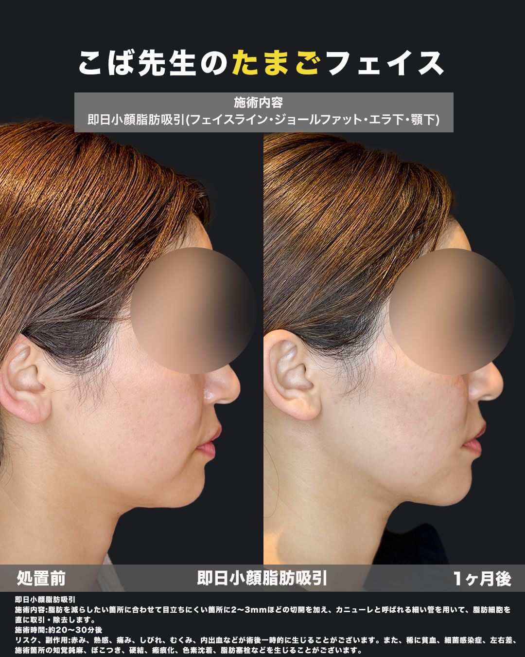 即日小顔脂肪吸引（頬・ジョール・エラ・あご下）の症例 横（側面）