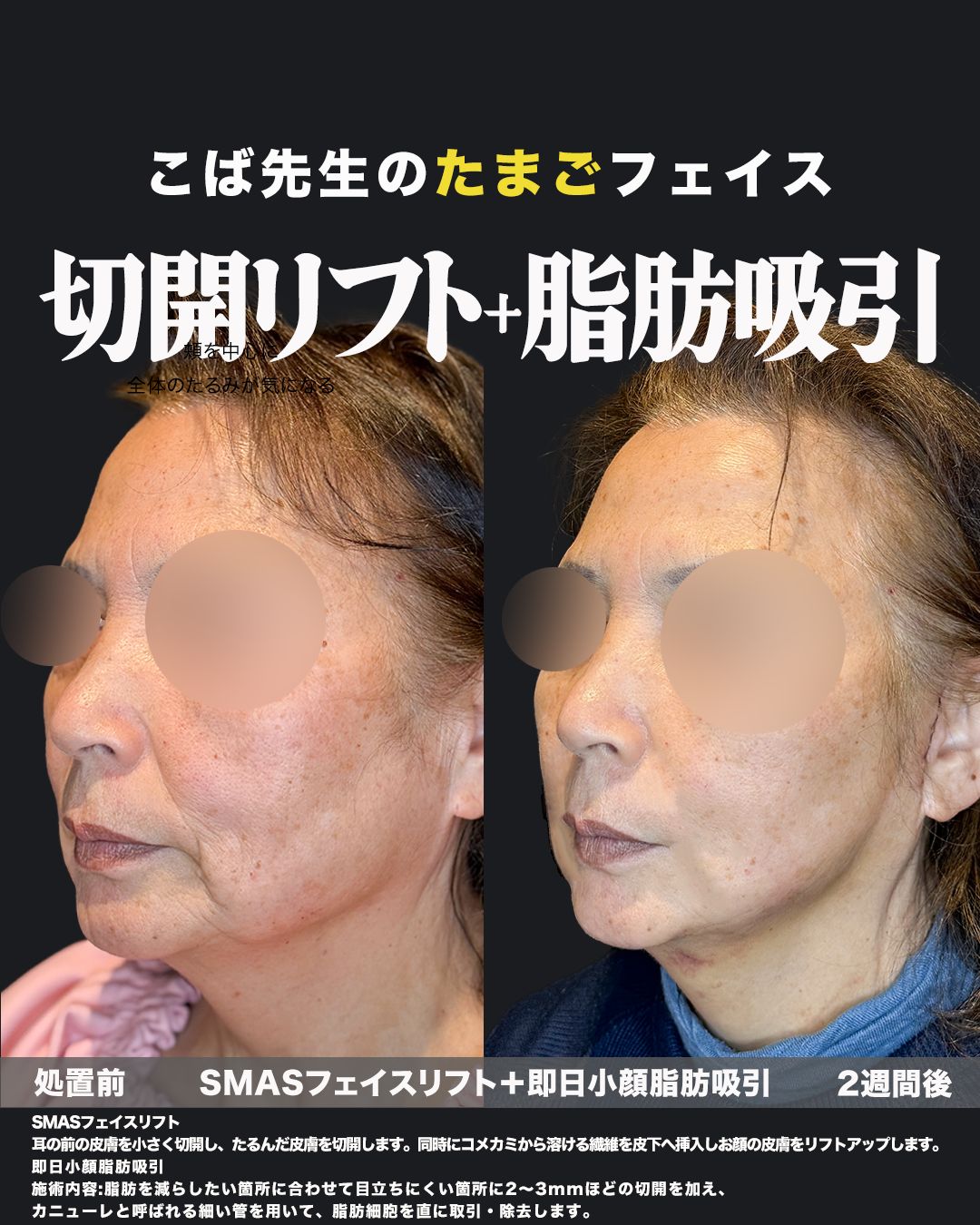 切開リフトと脂肪吸引の斜め横から見たビフォーアフター写真