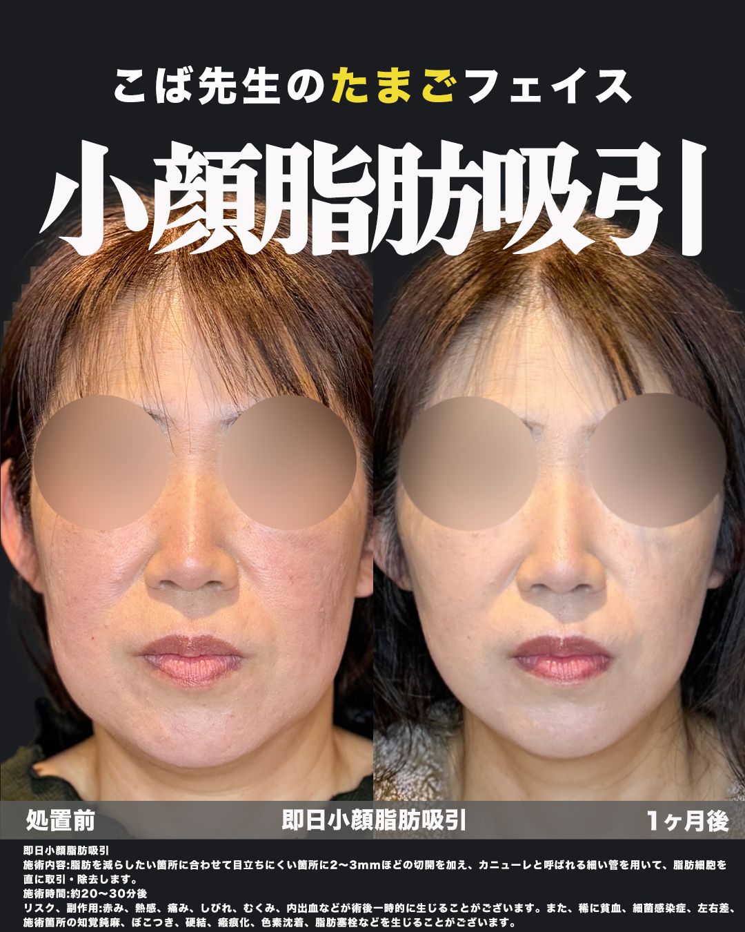 即日小顔脂肪吸引の施術前と1ヶ月後を正面から比較した症例画像