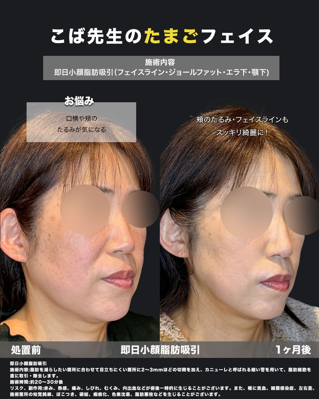 頬やフェイスラインの変化を斜めから比較した即日小顔脂肪吸引の症例画像