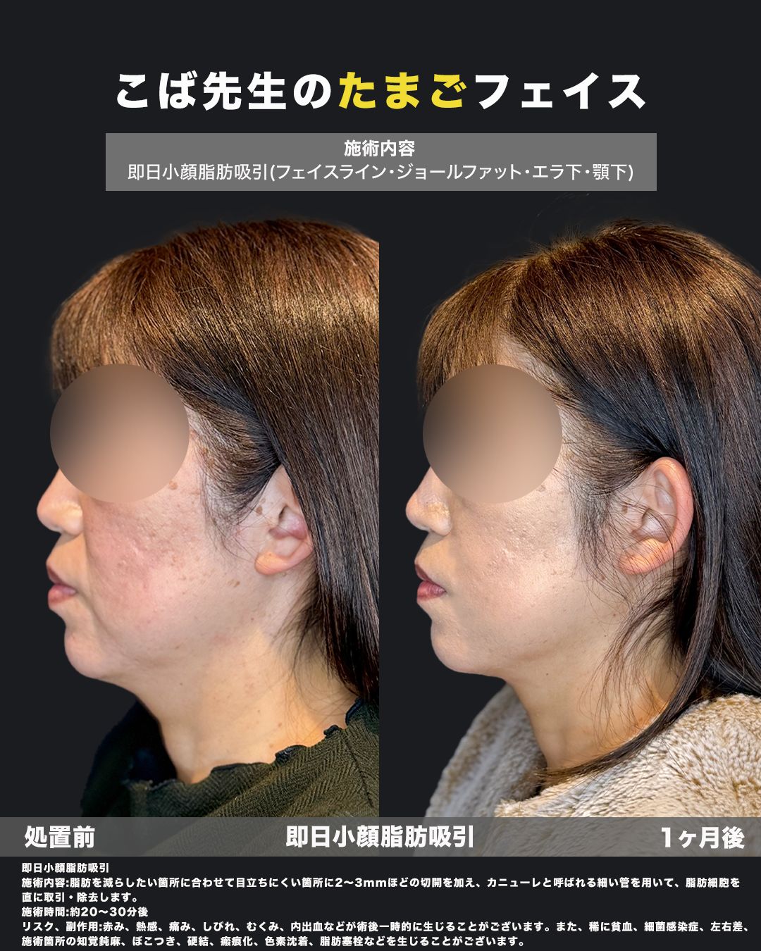 即日小顔脂肪吸引の施術前と1ヶ月後を横顔で比較した症例画像