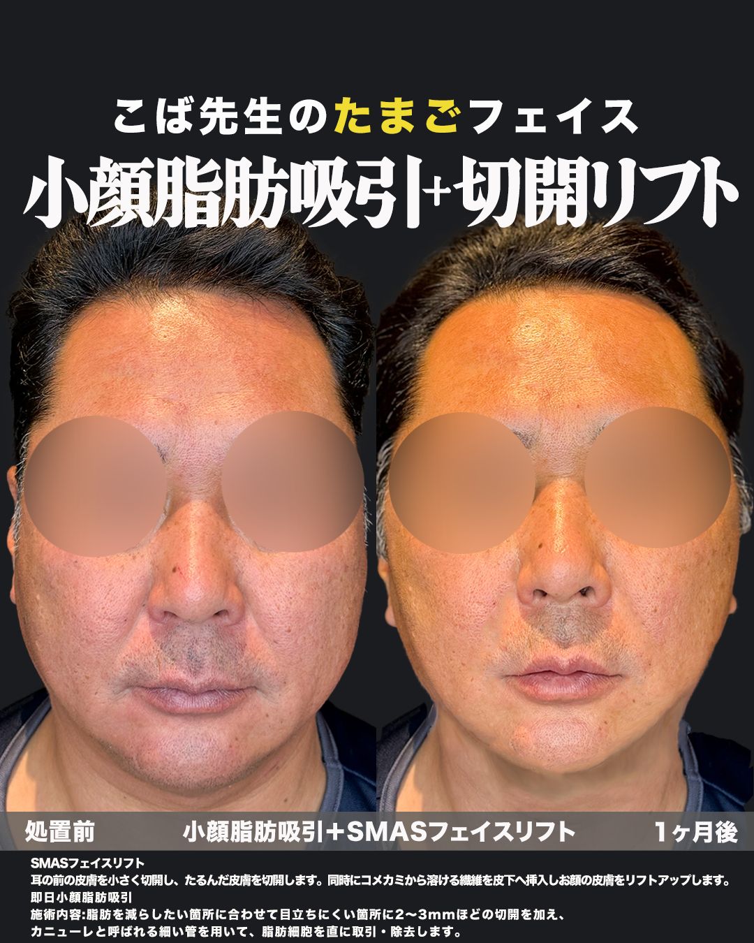 小顔脂肪吸引とSMASフェイスリフトの症例写真。男性の正面から見た処置前と1ヶ月後の比較