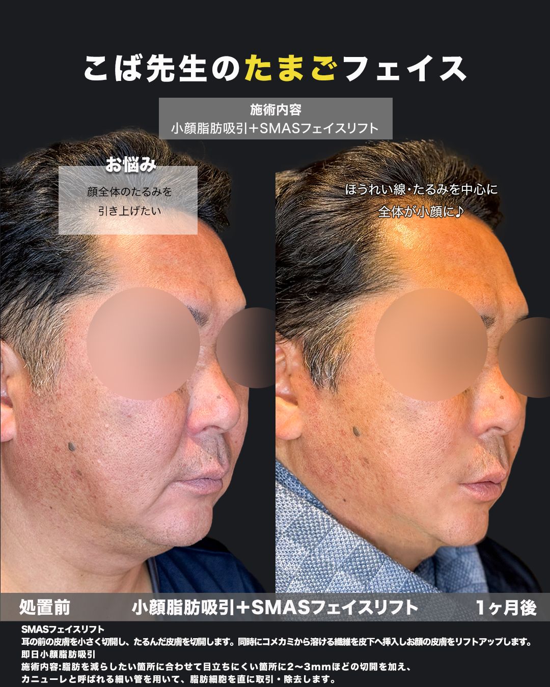 小顔脂肪吸引とSMASフェイスリフトの症例写真。男性の斜め前から見た処置前と1ヶ月後の比較